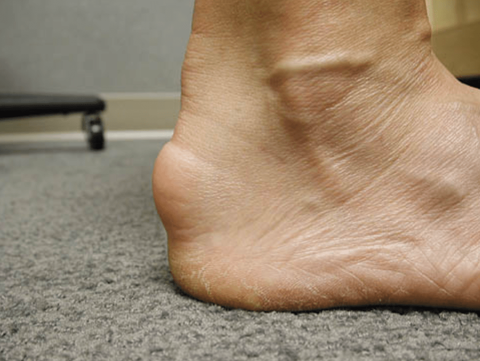 insertional achilles tendonitis