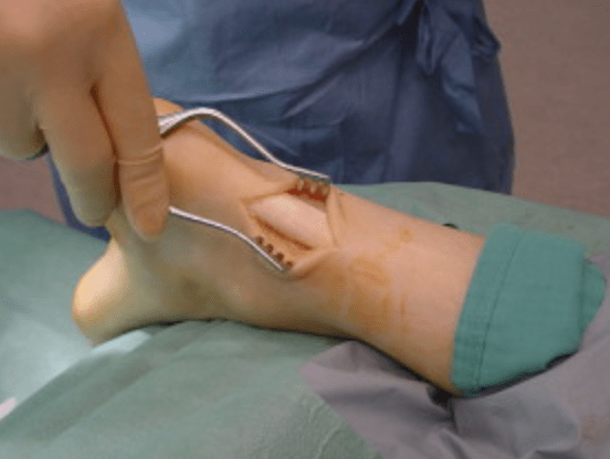 Non-insertional Achilles tendonitis