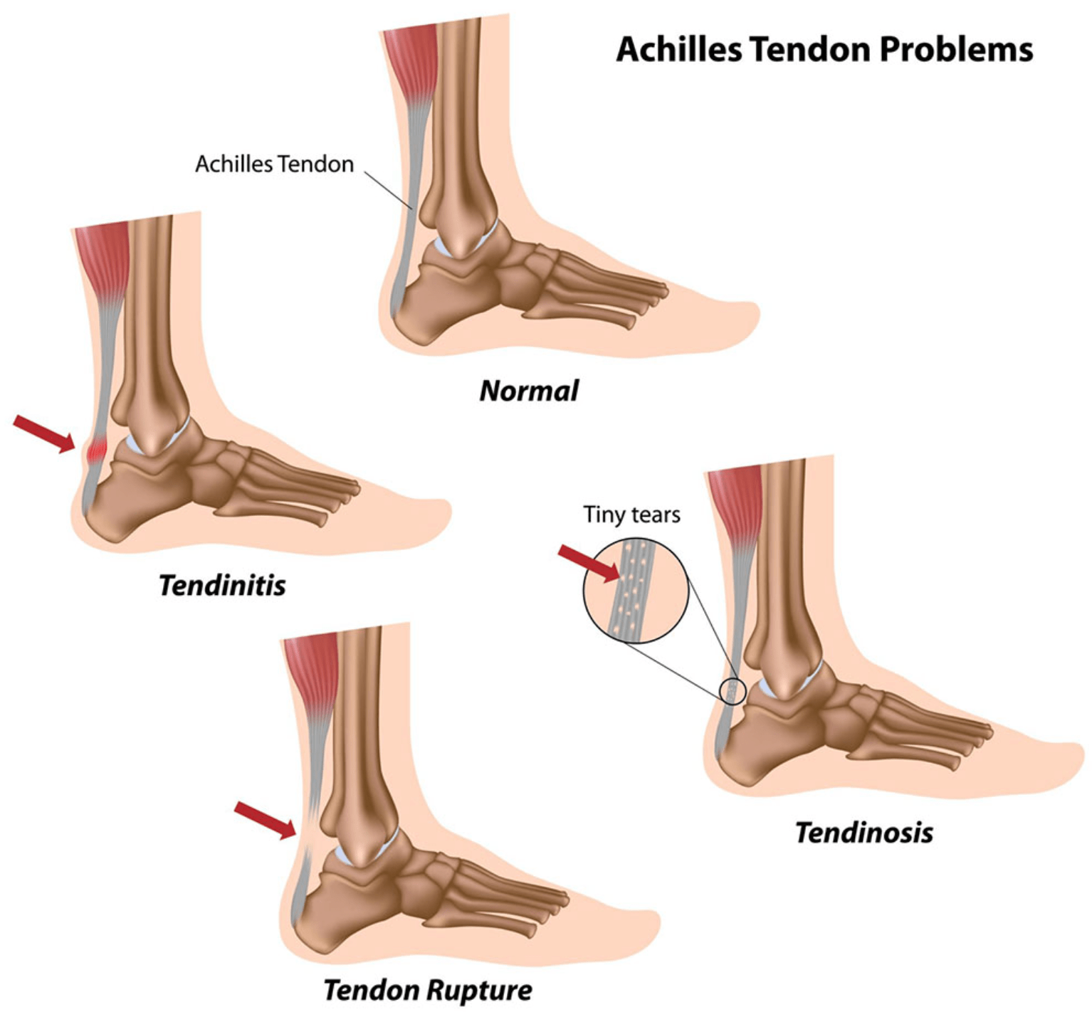 Rupture Achilles tendon injury