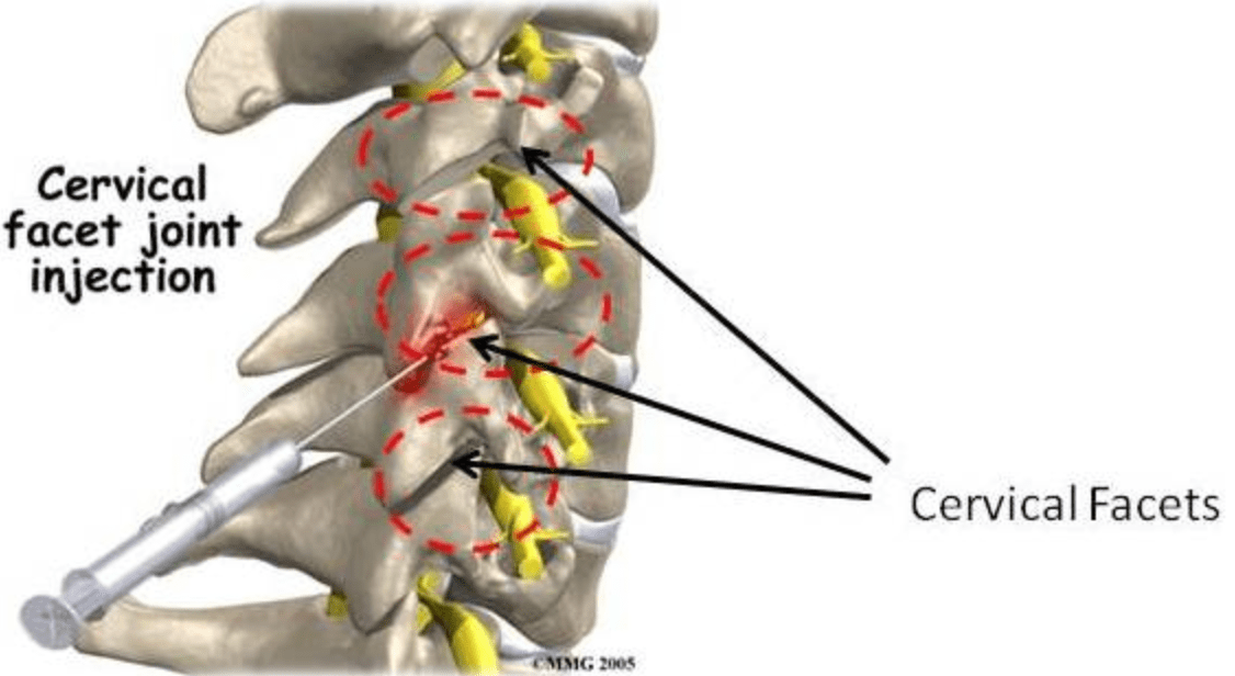 Understanding Cervical Facet Syndrome