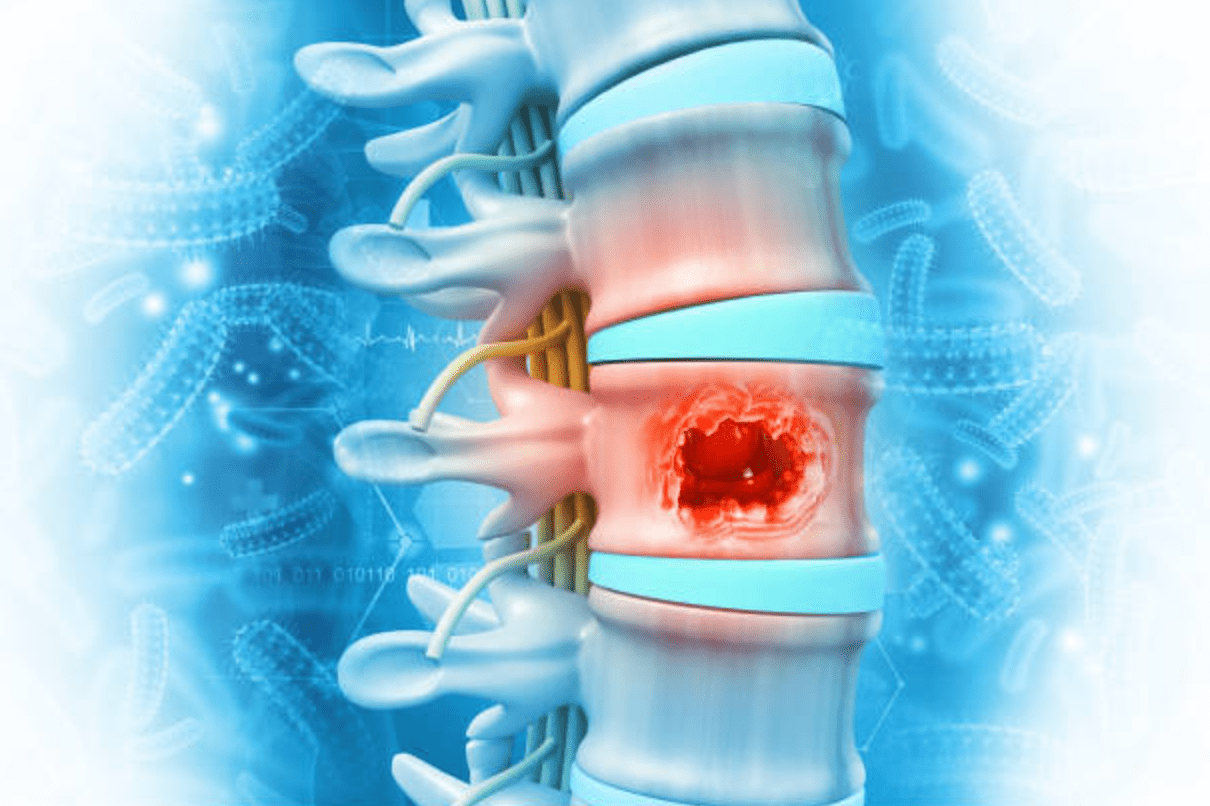 Understanding degenerative disc disease, how does degenerative disc disease look