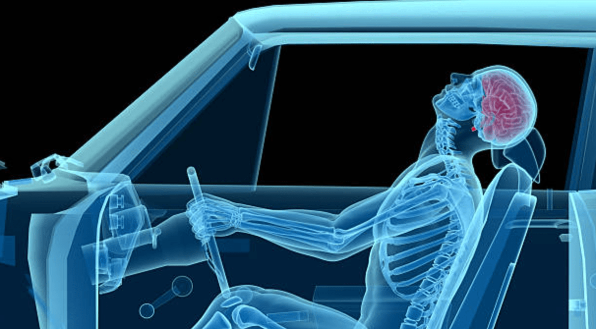 Whiplash can lead to cervical facet syndrome